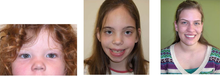 Three females—a toddler, a preteen, and a young woman—with trisomy X. The toddler and the preteen both have slight dysmorphic features; their eyes are spaced slightly wider apart than average, and the toddler has an extra fold of skin in the inner corners of her eyes. The young woman has no dysmorphic features.