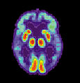 PET scan of brain with AD - Image courtesy of US National Institute on Aging Alzheimer's Disease Education and Referral Center