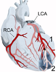 Myokardinfarkt der Vorderwandspitze (2) nach Verschluss (1) des vorderen absteigenden Astes (LAD) der linken Kranzarterie (LCA), schematische Darstellung