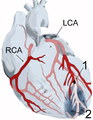 Diagram of a myocardial infarction