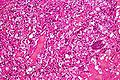 Micrograph of cerebellar hemangioblastoma. HPS stain.
