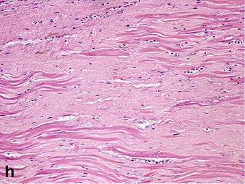 Replacement fibrosis in myocardial infarction, being boundless and dense.