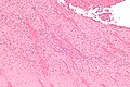 Intermediate magnification micrograph showing laminations in a thrombus in a fatal pulmonary embolism. H&E stain.