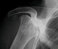 Radiography of total avascular necrosis of right humeral head. Woman of 81 years with diabetes of long evolution.
