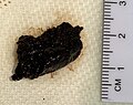 Gross pathology of melanoma metastasis, which is pigment-forming in a vast majority of cases, giving it a dark appearance.