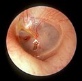 The oval perforation in this left tympanic membrane was the result of a slap on the ear