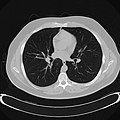 Chest CT (axial lung window)