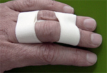 „Buddy Taping“ bei Verletzung des ulnaren Seitenbandes am Mittelfinger oder des radialen am Ringfinger.