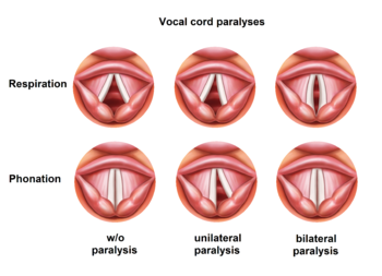 vocal cord positions regarding paralyses