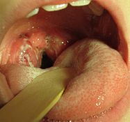 A set of large tonsils in the back of the throat, covered in white exudate. This is a culture-positive case of streptococcal pharyngitis with typical tonsillar exudate in an 8-year-old.