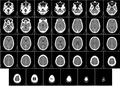 Computed tomography of human brain