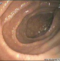 Endoscopic still of duodenum of patient with celiac disease showing scalloping of folds.