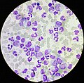 Chronic myelogenous leukemia