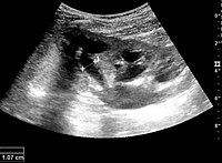 Figure 16. Hydronephrosis with dilated anechoic pelvis and calyces, along with cortical atrophy. The width of a calyx is measured on the US image in the longitudinal scan plane, and illustrated by ‘+’ and a dashed line.[1]