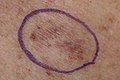 Malignant Melanoma in situ, right upper medial back, marked for biopsy