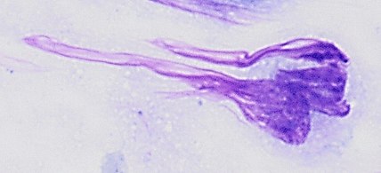 Pap stained smear of a monocyte with nuclear smearing or smudging artifact, seen as a tail-like extension of nuclear material