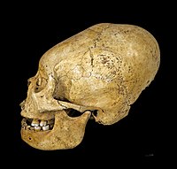 Proto Nazca elongated skull, c. 200–100 BCE
