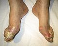 Gout complicated by ruptured tophi, the exudate of which tested positive for uric acid crystals