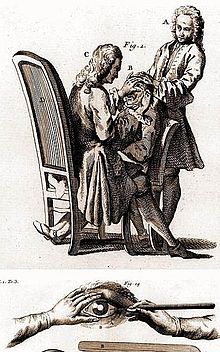 Engraved illustration of 18th century European surgeon performing a procedure on a seated patient, while an assistant steadies the patient's head from behind. A detail shows the instrument inserted through an incision in the sclera just beyond the edge of the cornea.