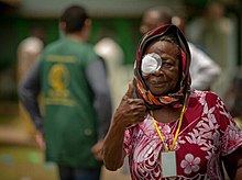 Woman walking in a street, wearing an adhesive patch over her right eye