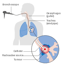 A machine attached to a tube that goes into a person's mouth and into a bronchus. At the end, an object emits radiation at a lung tumor.