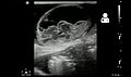 Ultrasound showing an incarcerated umbilical hernia[9]