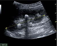 Figure 19. Centrally-located stone with posterior shadowing. No hydronephrosis is present. Measurement of kidney length on the US image is illustrated by ‘+’ and a dashed line.[1]