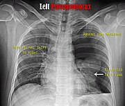 Chest X-ray showing the features of pneumothorax on the left side of the person (right in image)