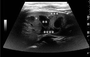 Figure 2. Normal pediatric kidney. * Column of Bertin; ** pyramid; *** cortex; **** sinus.[1]