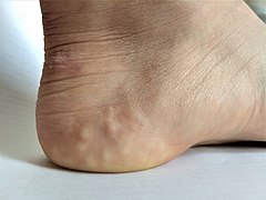 Piezogenic papules on the heel of an individual with hypermobile EDS