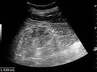 Figure 22. Chronic renal disease caused by glomerulonephritis with increased echogenicity and reduced cortical thickness. Measurement of kidney length on the US image is illustrated by ‘+’ and a dashed line.[1]