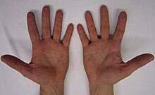 Rash on palms of the hands.