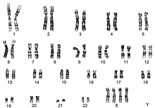 A karyotype, or image of chromosomes, for tetrasomy X. The chromosomes are labelled 1 to 22 for the autosomes (non-sex chromosomes), then X and Y for the sex chromosomes. 1 to 22 have the normal number of two chromosomes each. The Y is empty, and the X has four chromosomes.