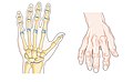 Bone (left) and clinical (right) changes of the hand in osteoarthritis