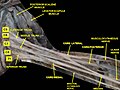 Brachial plexus. Deep dissection. Anterolateral view