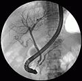 ERCP image showing the pancreatic duct and biliary tree.