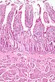 Micrograph of a small intestine neuroendocrine tumour. H&E stain.