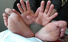 Rash on hands and feet of a 36-year-old man