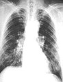 61-year-old working industrially with asbestos for decades