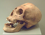 A deformed Atacameño skull