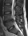 MRI scan of large herniation (on the right) of the disc between L4 and L5 vertebrae