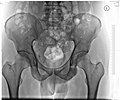Röntgenbild eines Beckens (Mann, 46 Jahre)