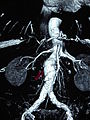 Abdominal aortic aneurysms (3.4 cm)