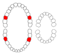 Zahnschema; Sechsjahrmolaren (rot), rechts das Milchgebiss