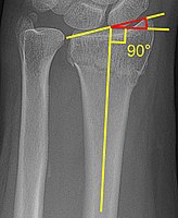 Radial inclination of distal radius fracture