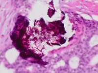 Histopathology of dystrophic calcium phosphate microcalcifications in ductal carcinoma in situ (DCIS) of the breast, H&E stain.
