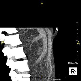 Lateral MIP view in the same patient as previous image