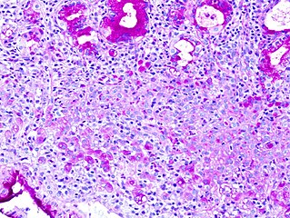 Signet ring cells (magenta) stained with PAS in a gastric signet ring cell carcinoma.