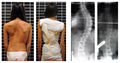Scoliosis. - By Weiss HR - CC BY 2.0