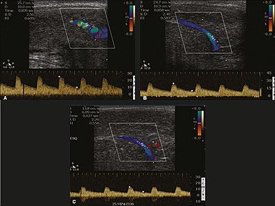 Longitudinal, ventral ultrasound of the penis, with pulsed mode and color Doppler. Flow of the cavernous arteries at 5, 15, and 25 min after prostaglandin injection (A, B, and C, respectively). The cavernous artery flow remains below the expected levels (at least 25–35 cm/s), which indicates ED due to arterial insufficiency.[45]